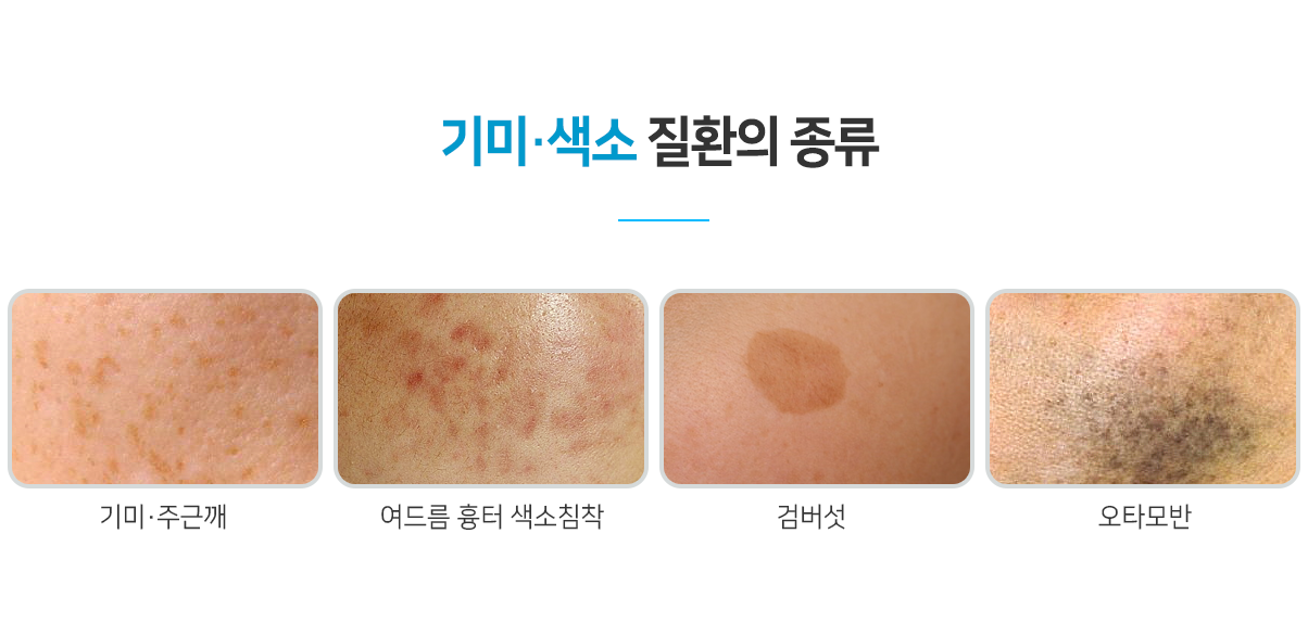 명일동피부과 기미잡티치료 색소 질환 종류 분류 인포그래픽