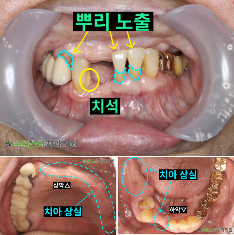 처음 내원 시 구강 내부 사진, 80대 여성(2026. 3 촬영)