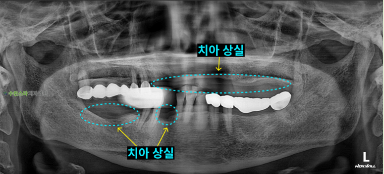 처음 내원 시 파노라마, 80대 여성(2026. 3 촬영)
