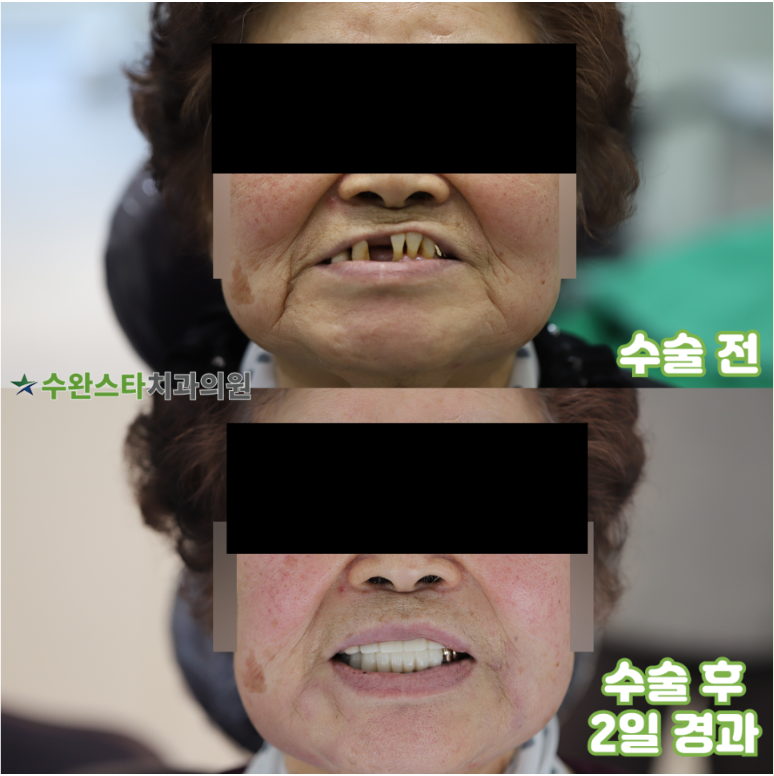 수술 전 / 수술 후 2일 경과, 80대 여성 (2026. 3 촬영)