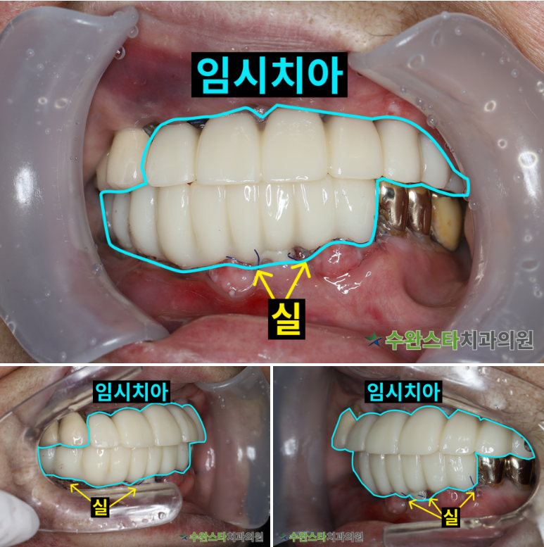 수술 2일 후 임시치아, 80대 여성(2026. 3 촬영)