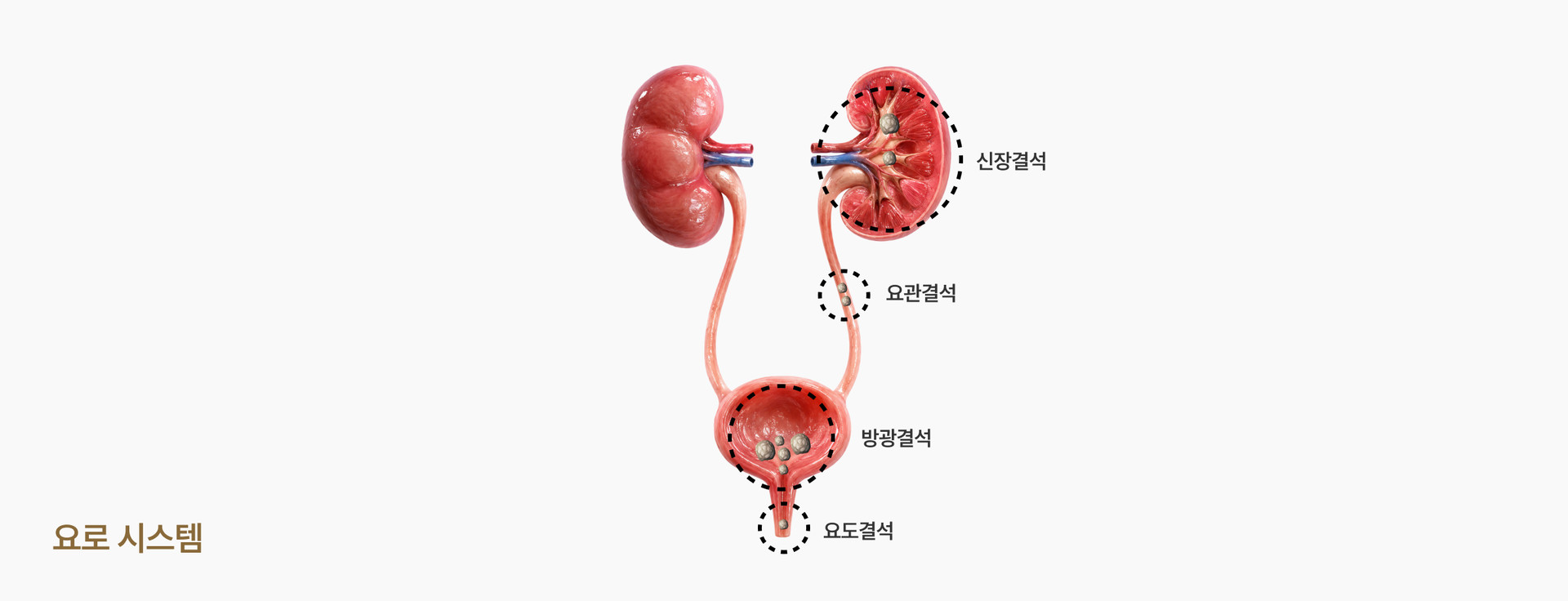 신장에서 요관·방광으로 이동하는 요로결석 그림