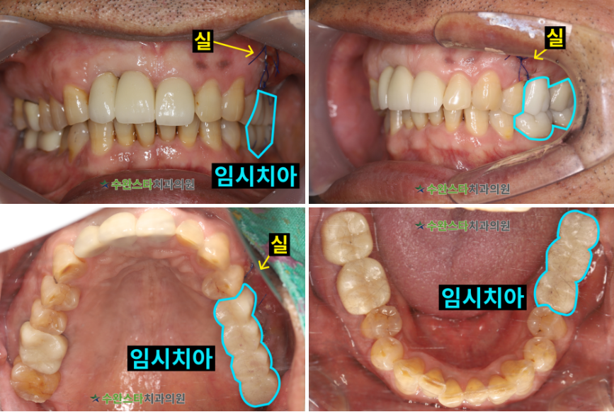 수술 2일 후 임시치아, 50대 남성 (2026. 4 촬영)