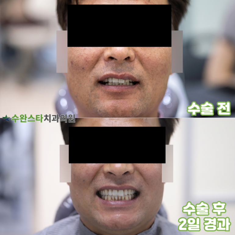 처음 내원 시 파노라마, 50대 남성 (2026. 4 촬영)  ​