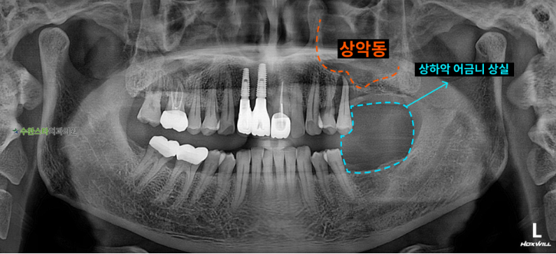 처음 내원 시 파노라마, 50대 남성(2026.4)