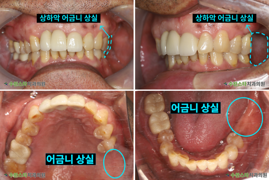 처음 내원 시 구강 내부 사진, 50대 남성(2026. 4 촬영)