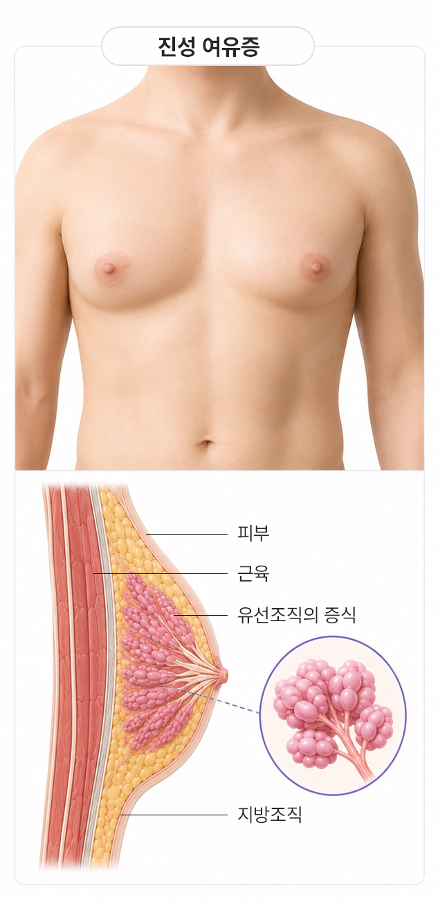 진성 여유증