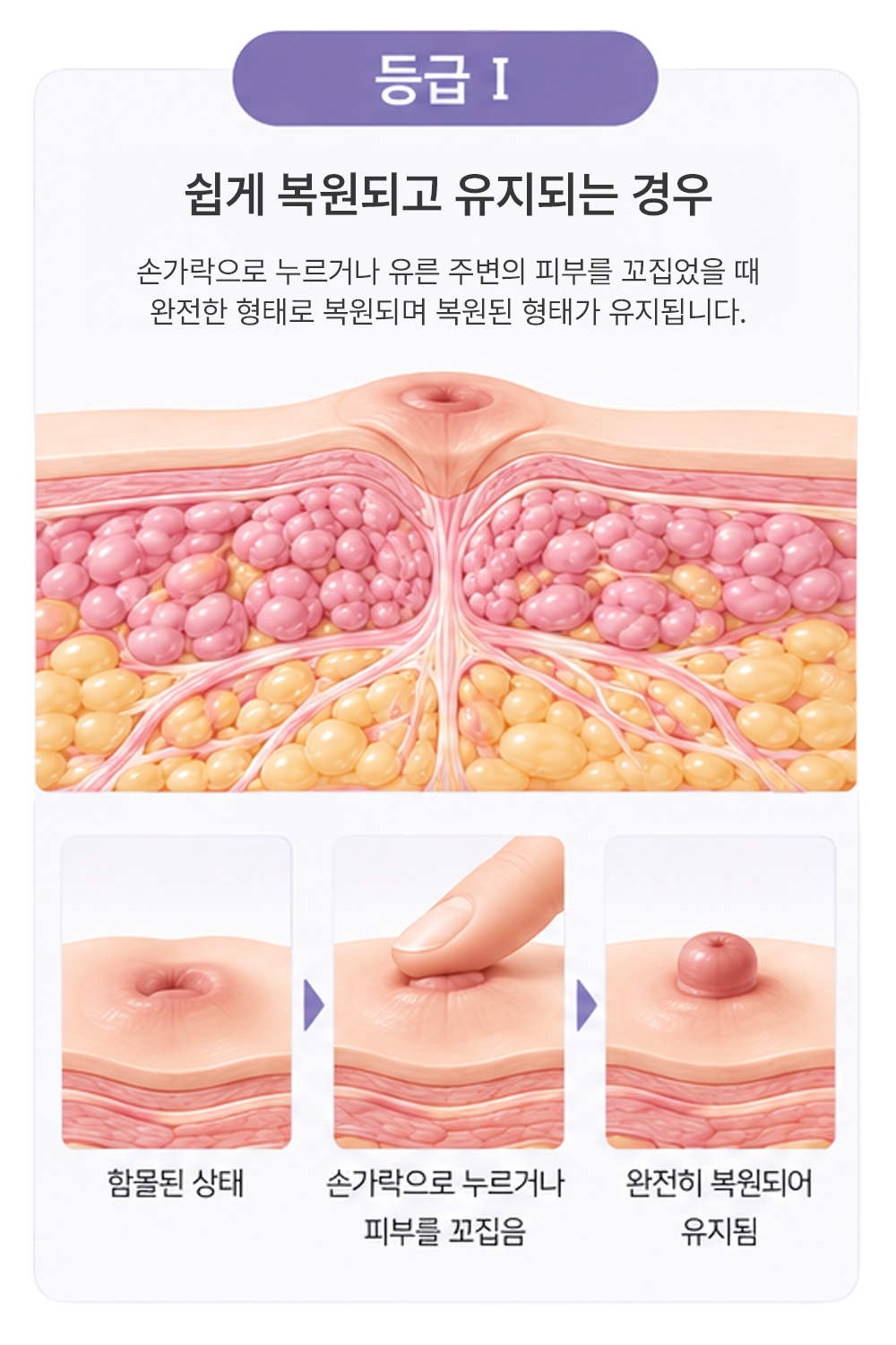 함몰 유두 1등급