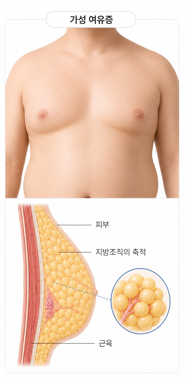 가성 여유증