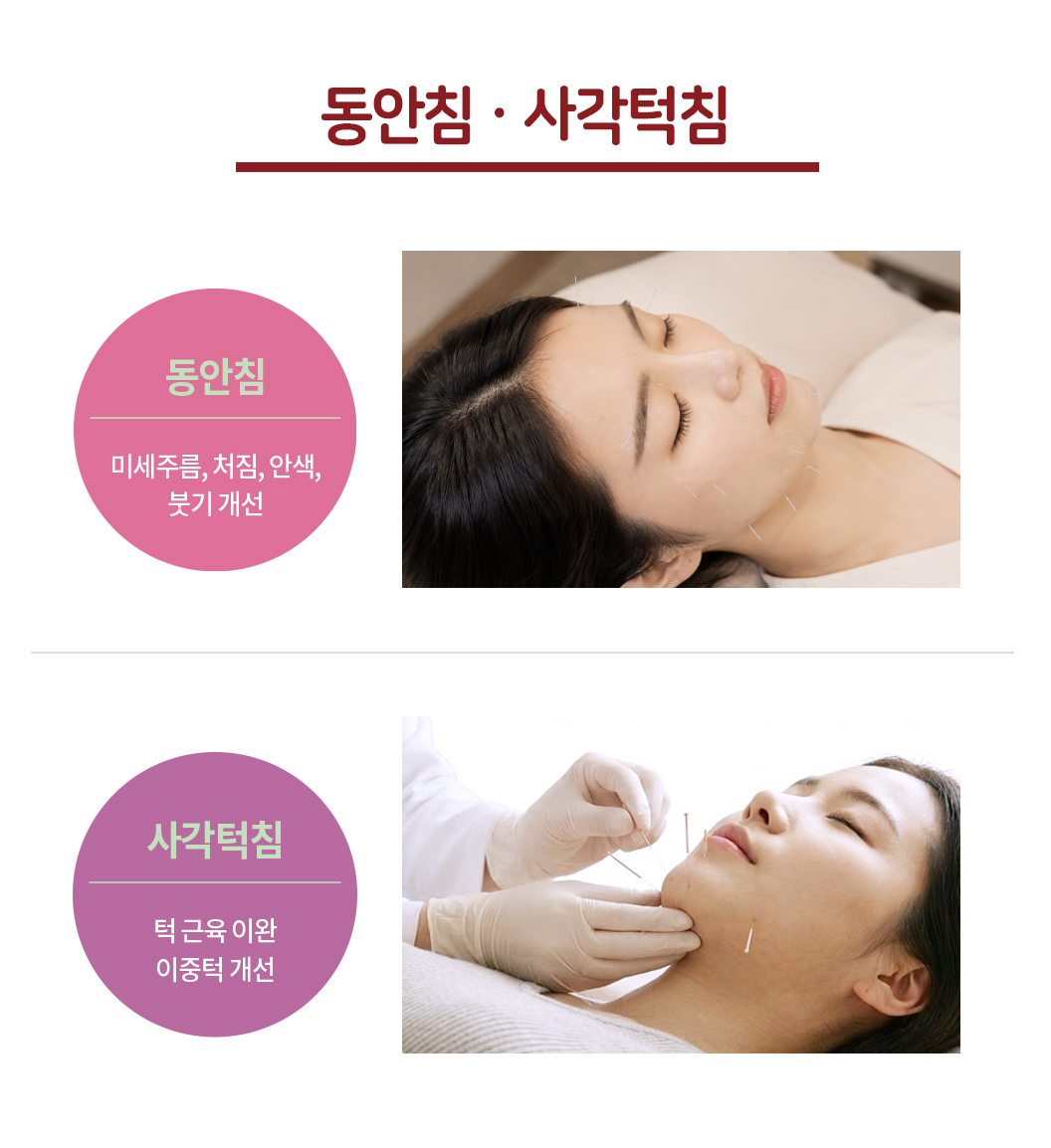대한민국365한의원_안면침(동안침), 사각턱침