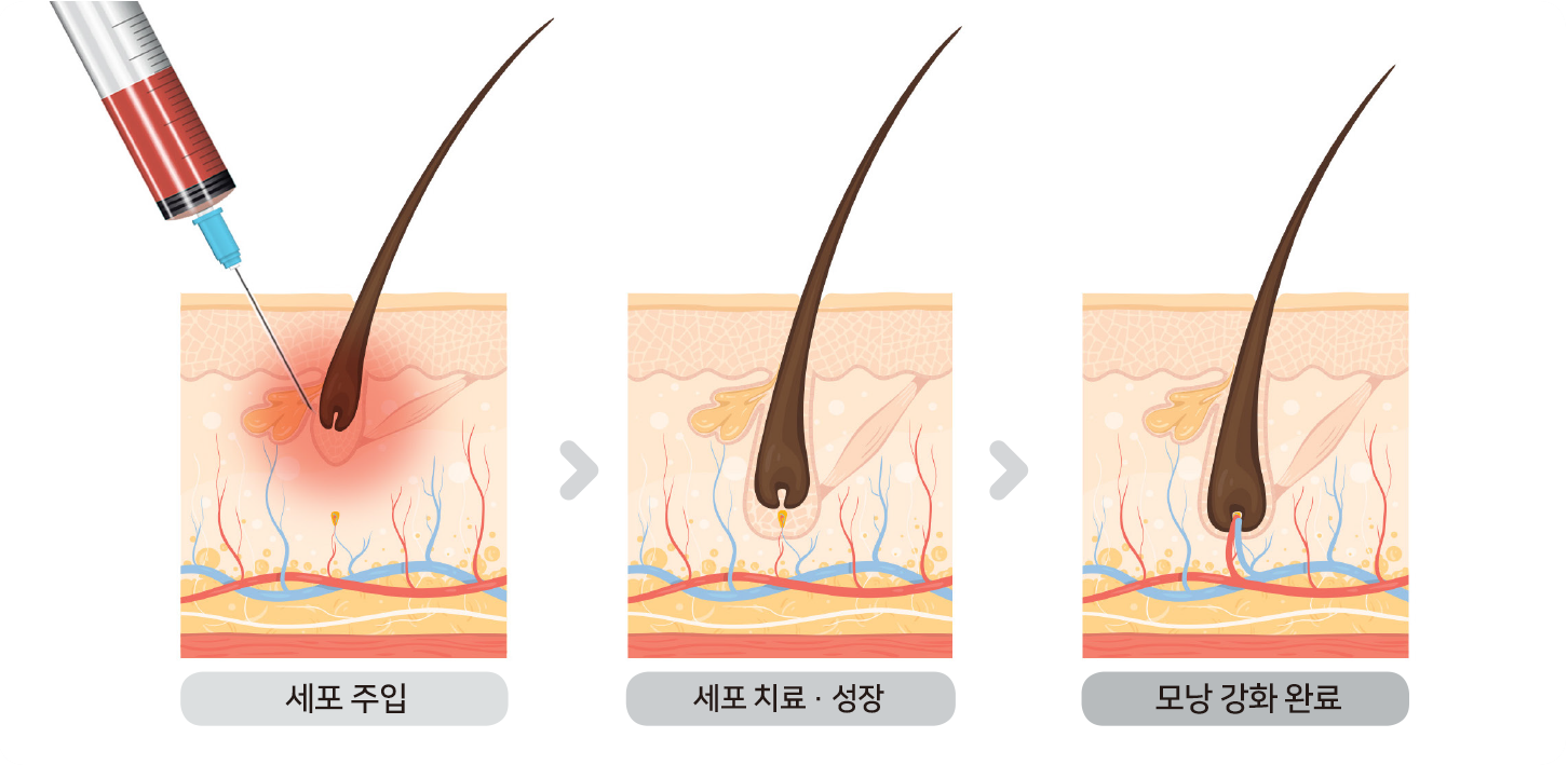 탈모 줄기세포