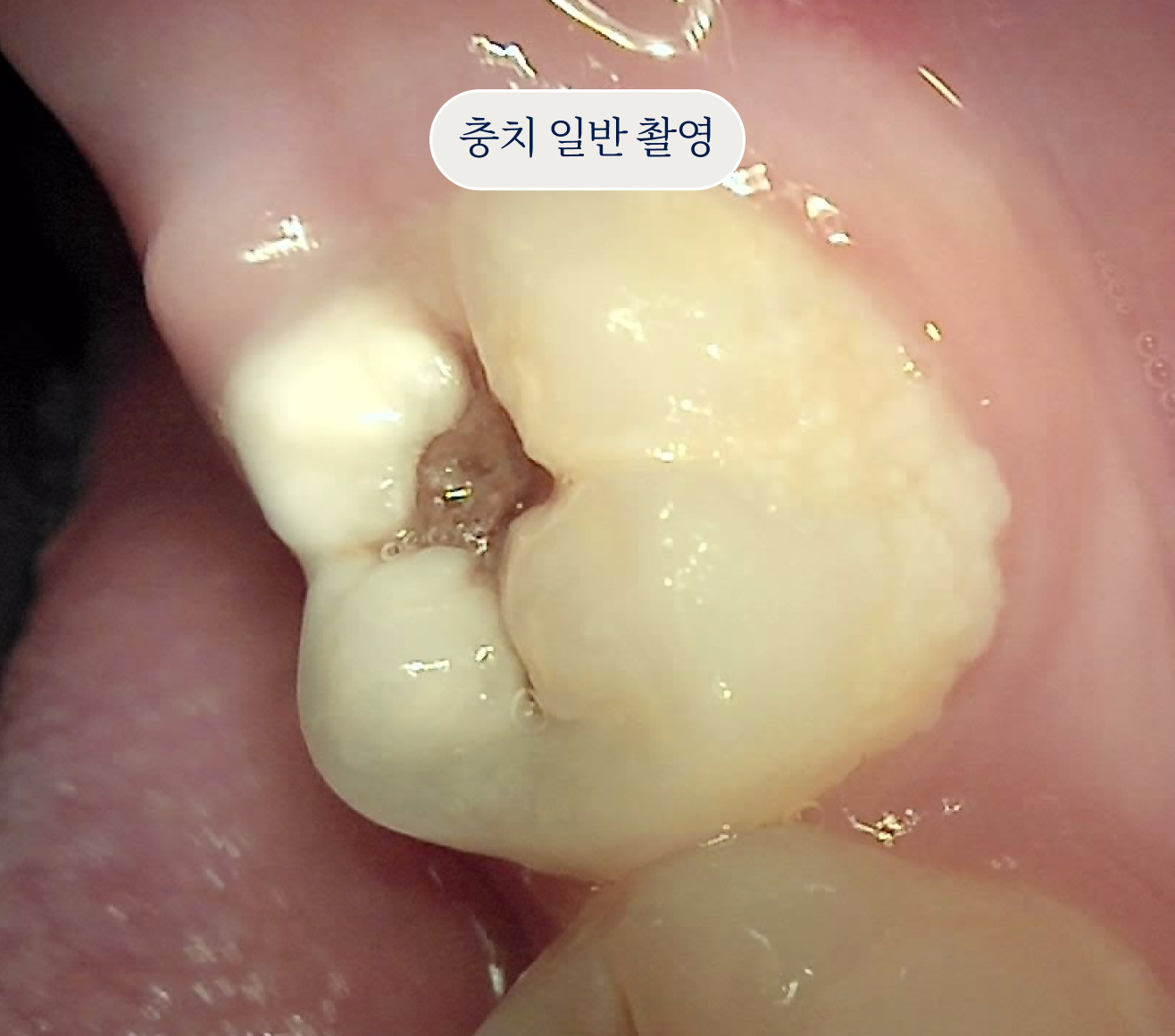 충치 일반 촬영