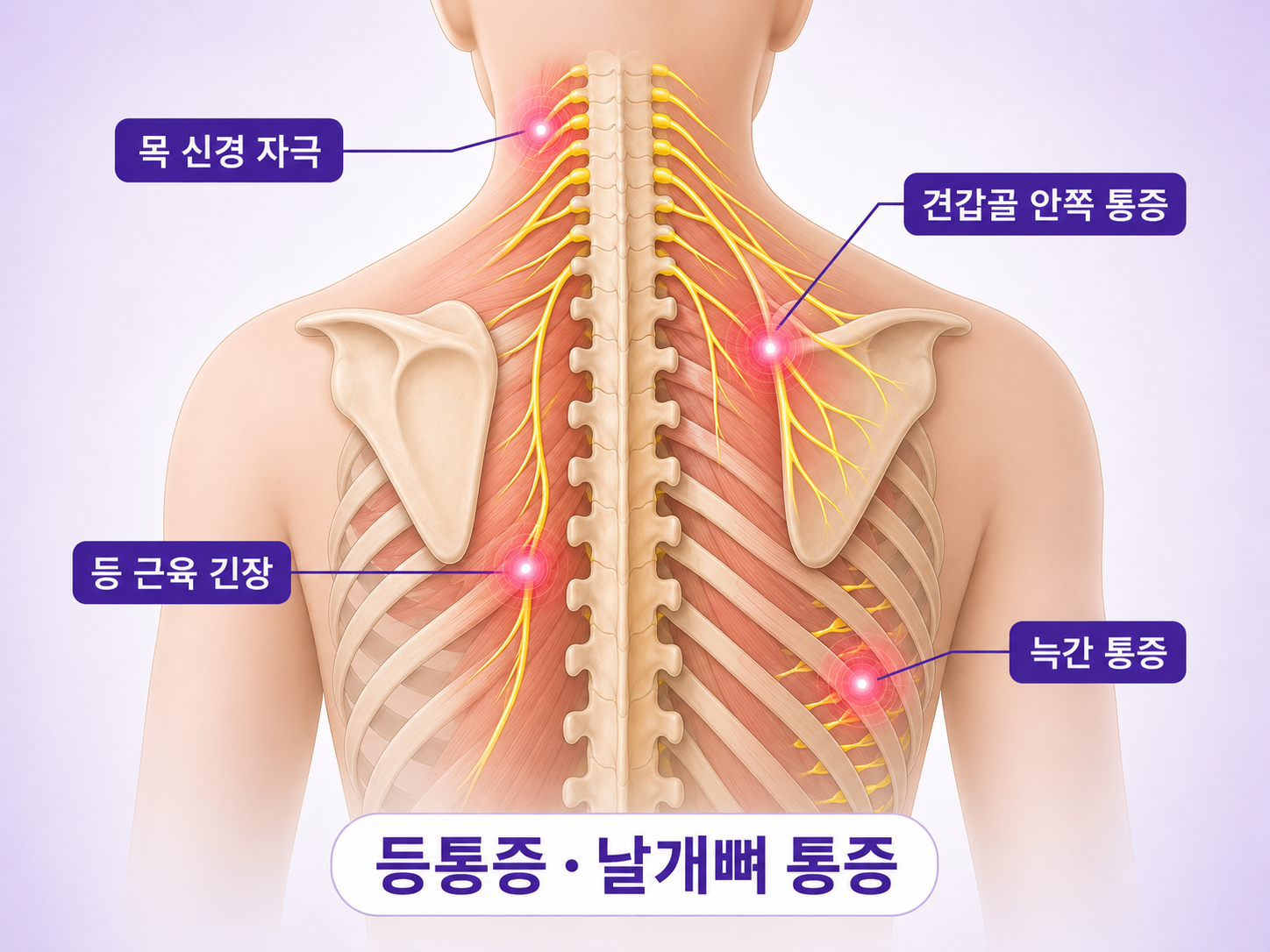 등 통증 날개뼈 통증 늑간신경 통증