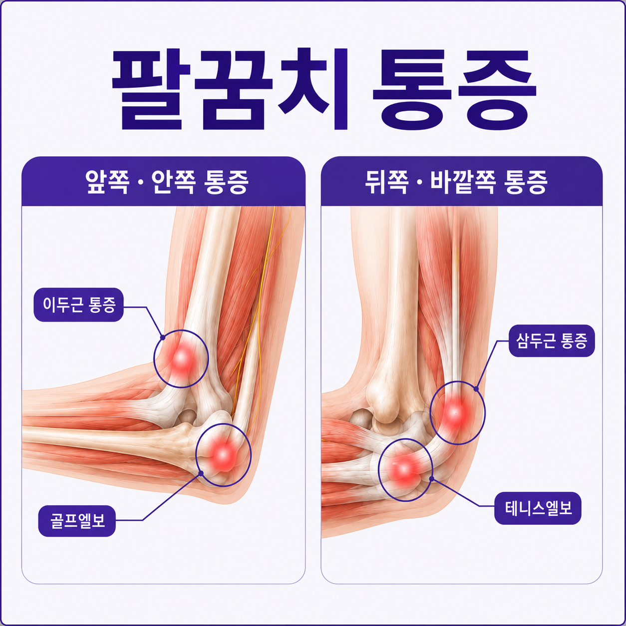 팔꿈치 통증 테니스엘보 골프엘보