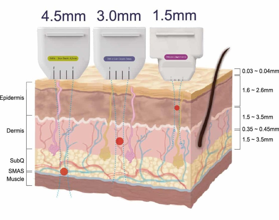 대전울쎄라 탐침 깊이별 1.5mm 3.0mm 4.5mm 도달 층위 비교 인포그래픽