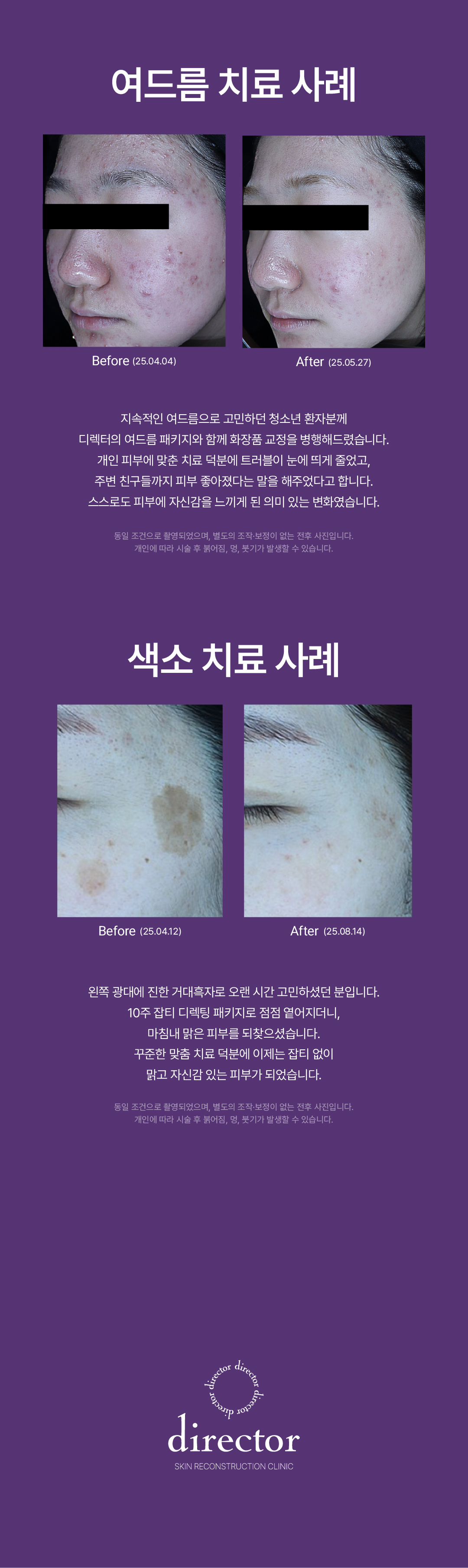 써마지 FLX – 잔주름 완화부터 턱선 탄력까지 개선하는 프리미엄 리프팅