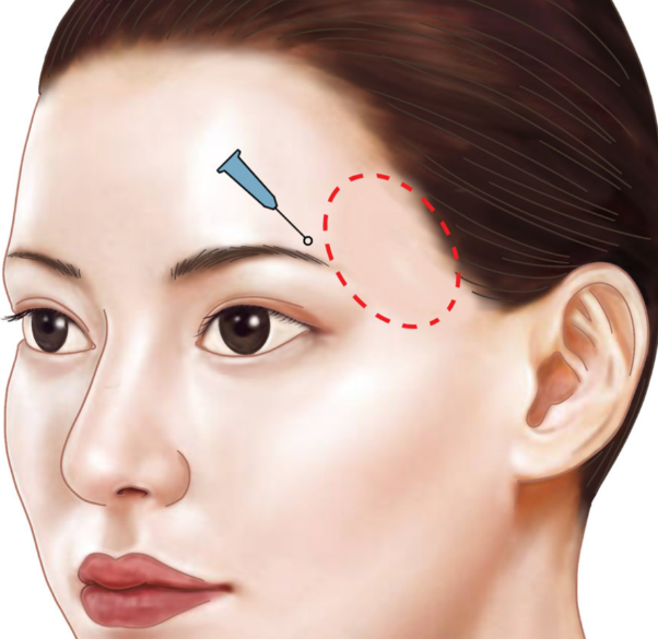 대전필러잘하는곳 관자놀이 부위 해부학 기반 필러 주입 가이드 이미지