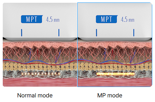 울산슈링크유니버스 MPT 4.5mm 카트리지 노멀모드 MP모드 진피층 시술 깊이 비교