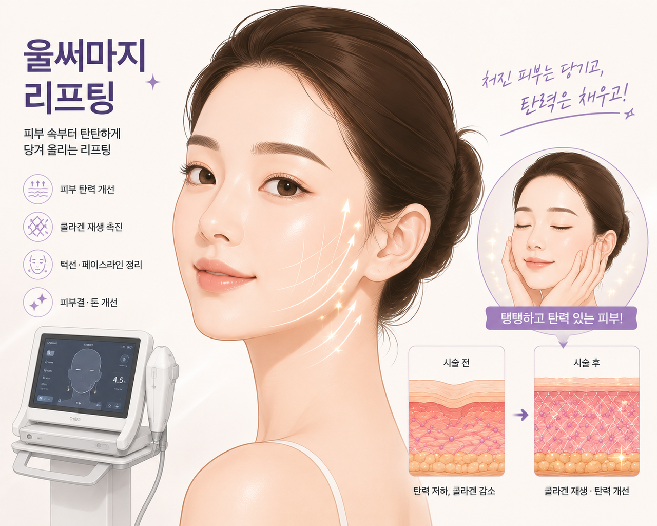 강남울써마지 피부 탄력 개선과 콜라겐 재생 효과를 소개하는 리프팅 시술 안내 이미지