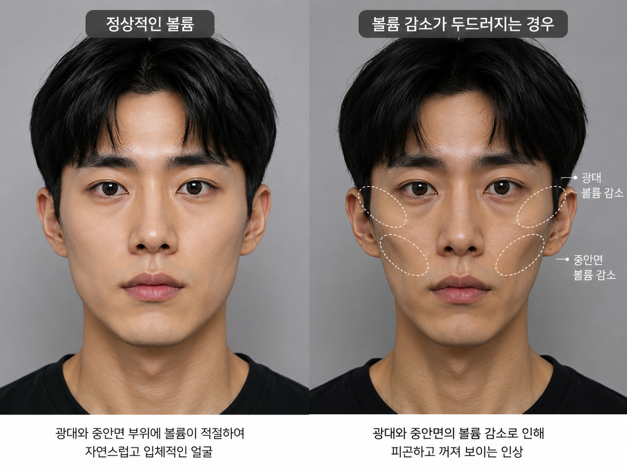 보톡스만으로 개선이 제한적인 모습