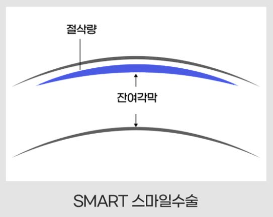 렌티큘 엣지 2