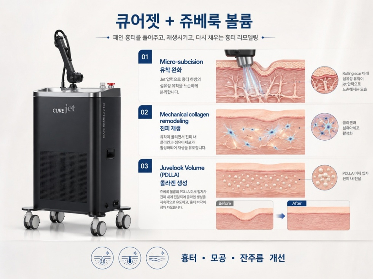 큐어젯 쥬베룩 볼륨 흉터 치료 원리