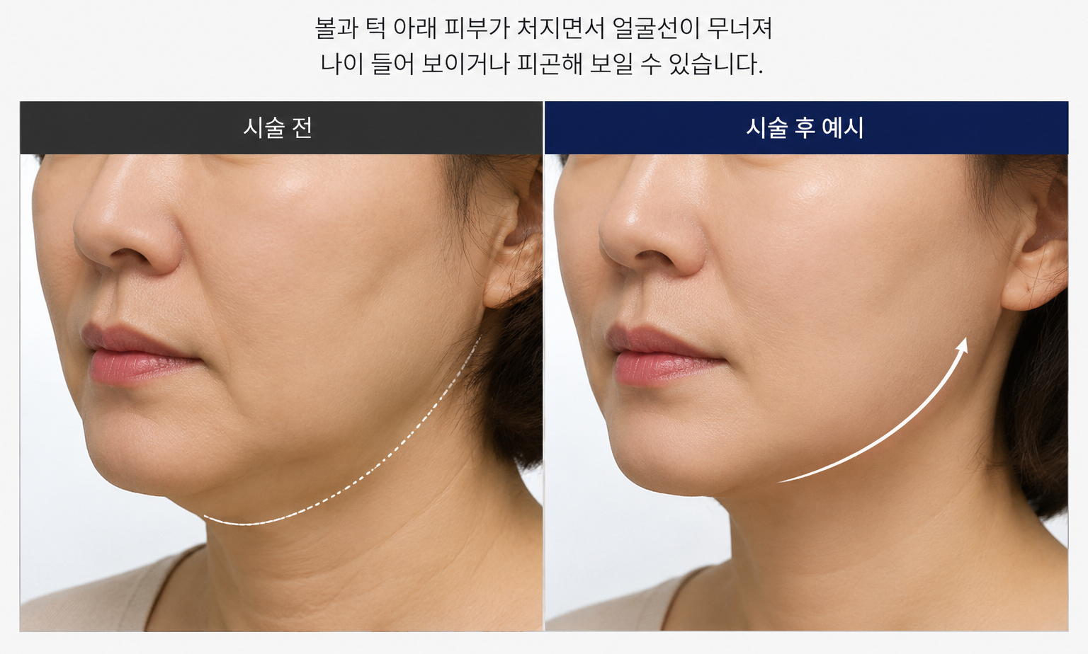 리프팅 추천대상