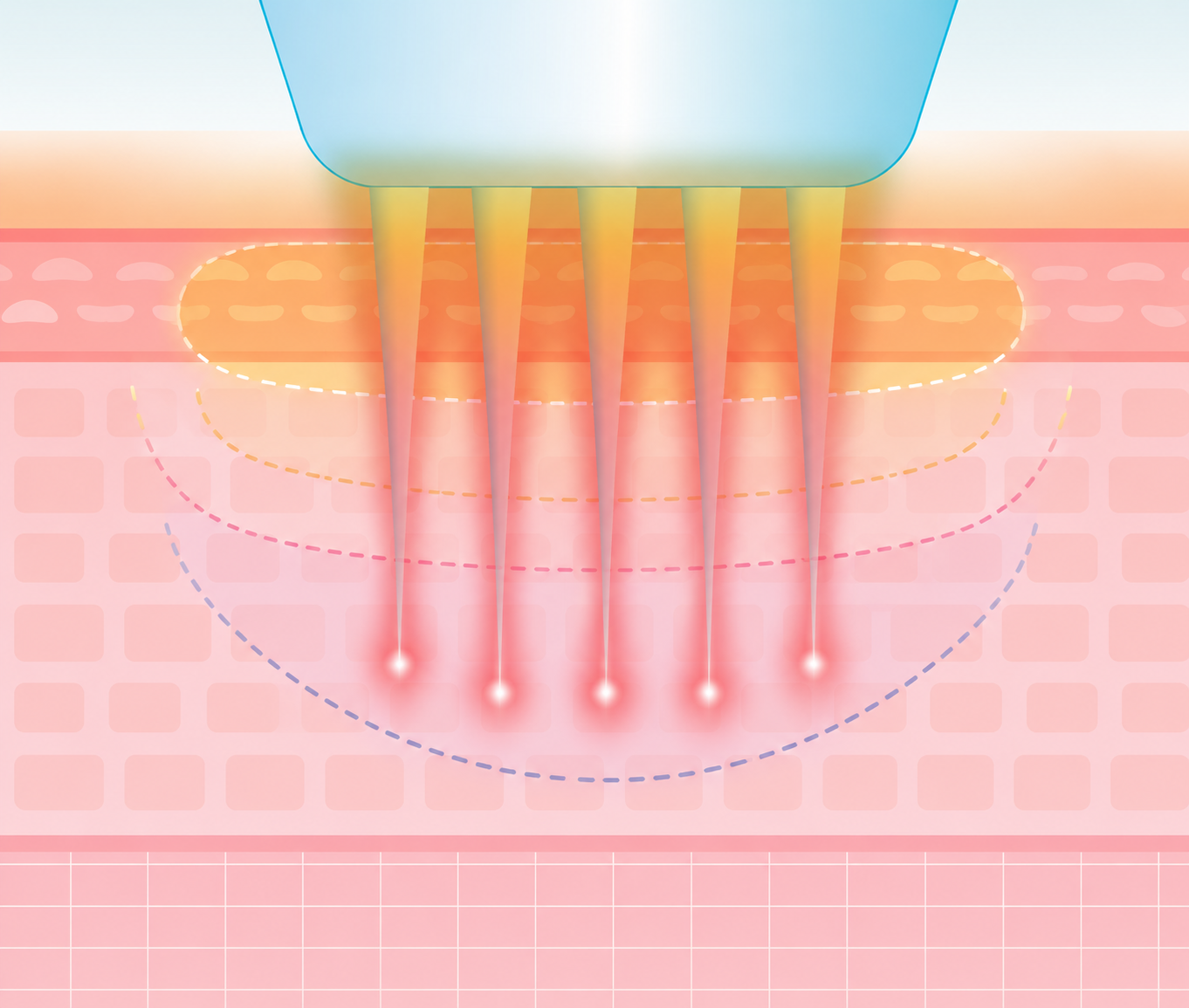 울써마지 맞춤 리프팅 디자인