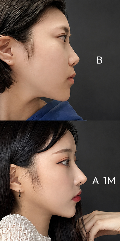 低い鼻筋 ビフォーアフター（手術