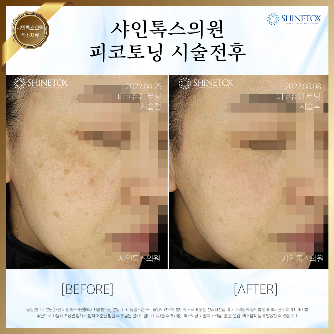 승모근보톡스 시술전후 사진
