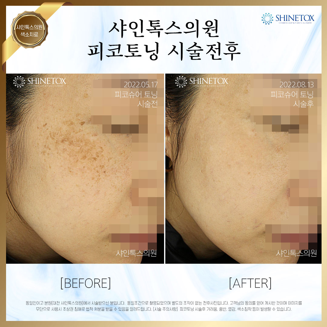 승모근보톡스 시술전후 사진