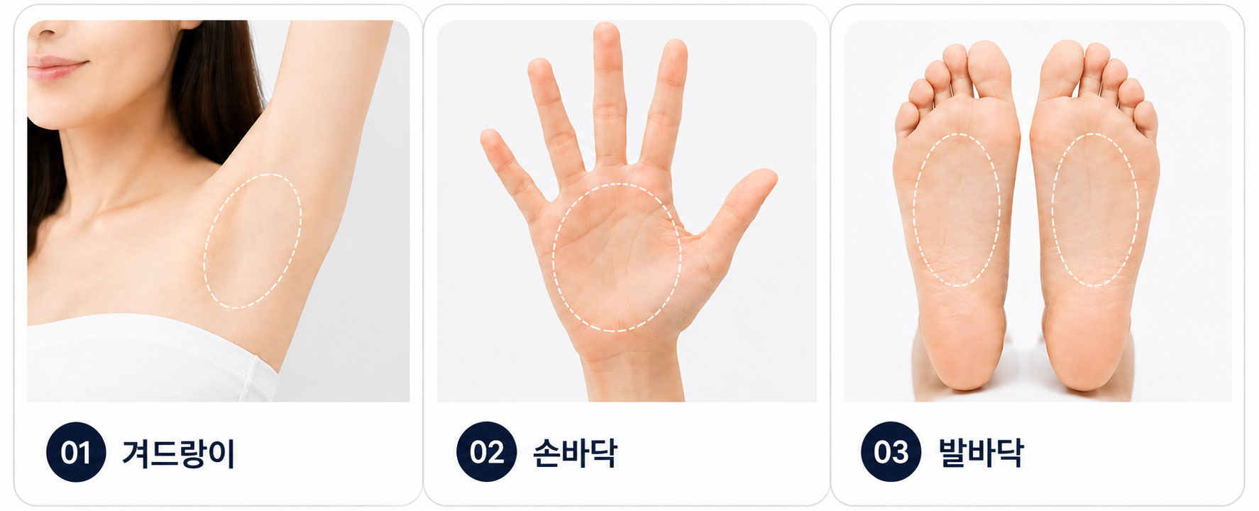 다한증보톡스 시술부위