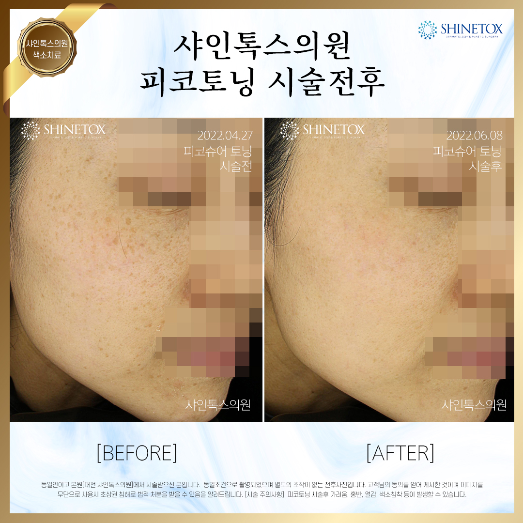 주근깨 시술사진1