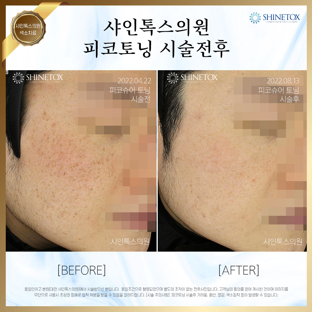주근깨 시술사진2