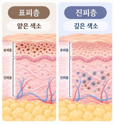 울산주근깨 색소 깊이별 표피층 진피층 비교 인포그래픽