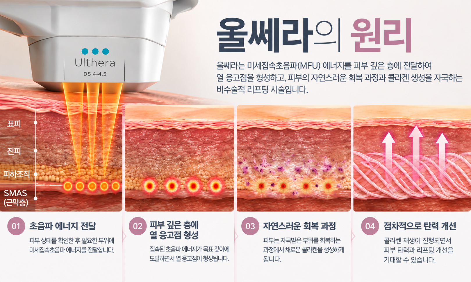 울쎄라의 원리