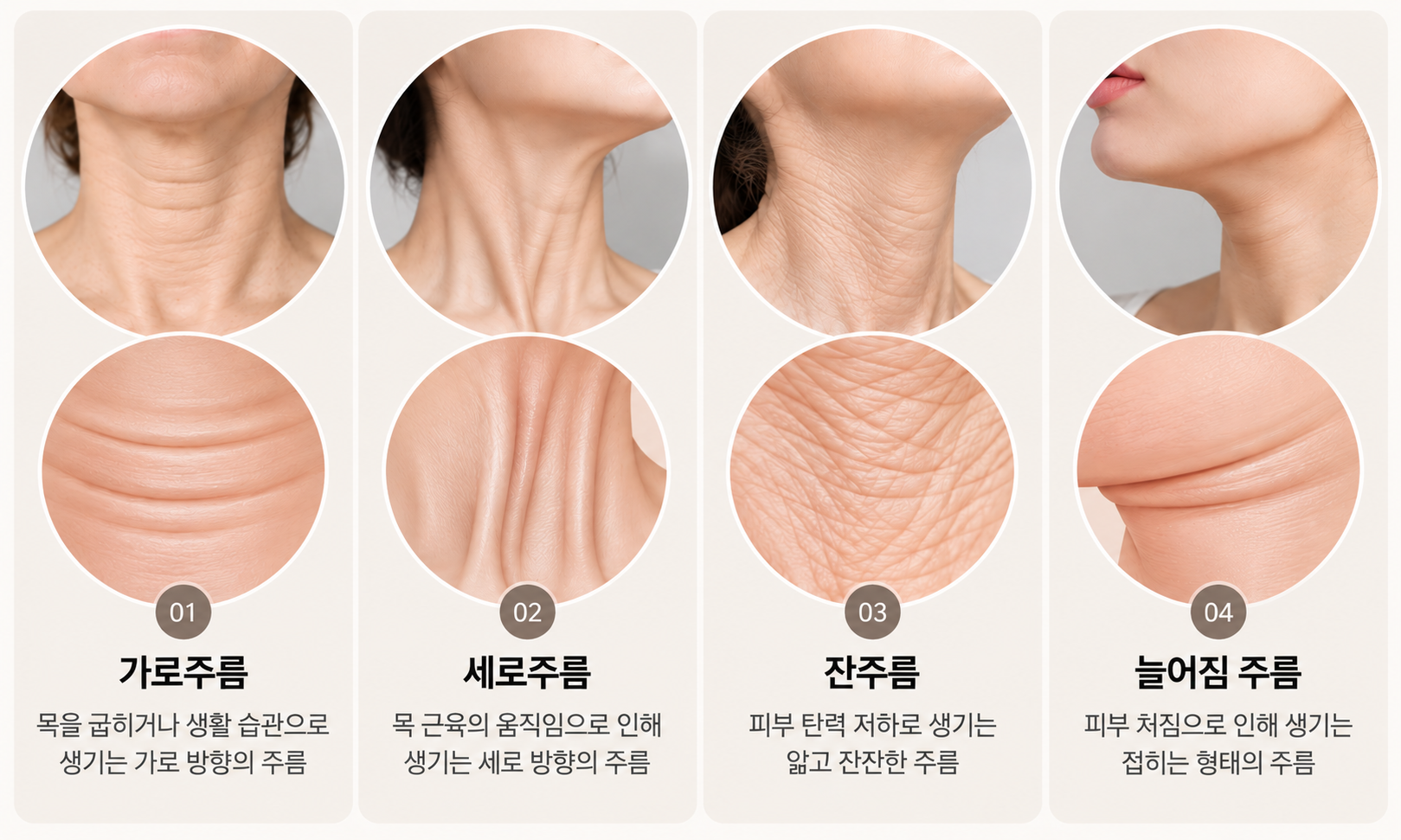 목주름 종류