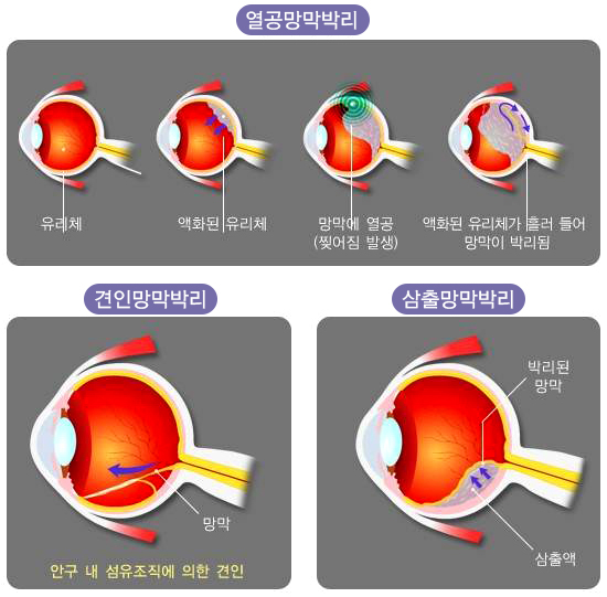 [원인에 따른 망막박리 종류]