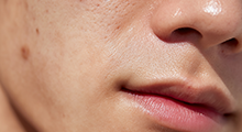 여성형 유방