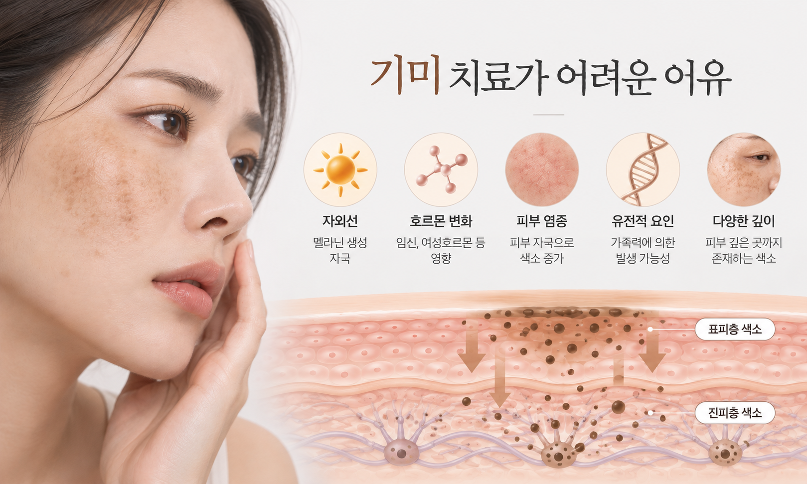 기미치료가 어려운 이유