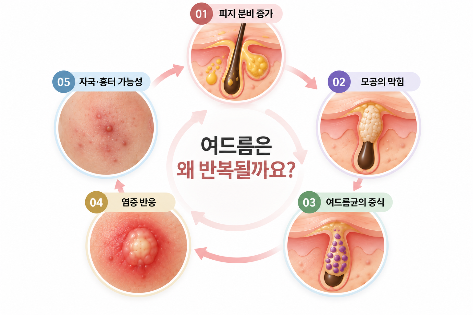 여드름의 반복