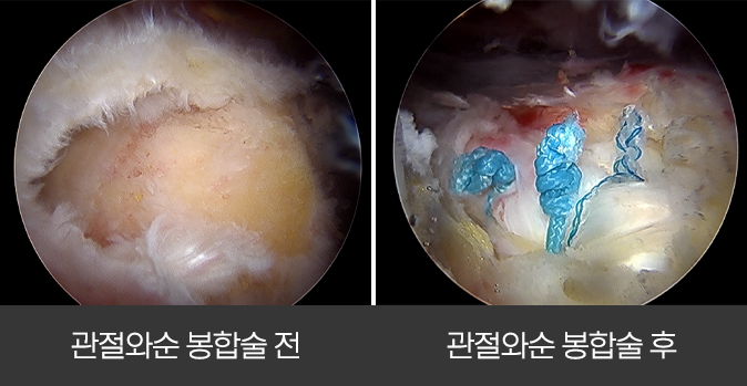 관절와순 봉합술