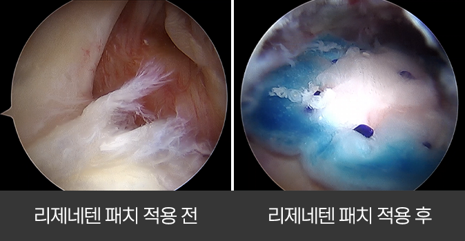 리제네텐 수술