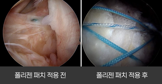 폴리젠 패치 보강술