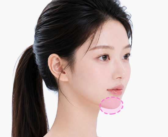 Customized 3D chin implant augmentation