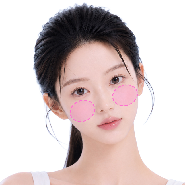 Customized 3D front cheek implant augmentation
