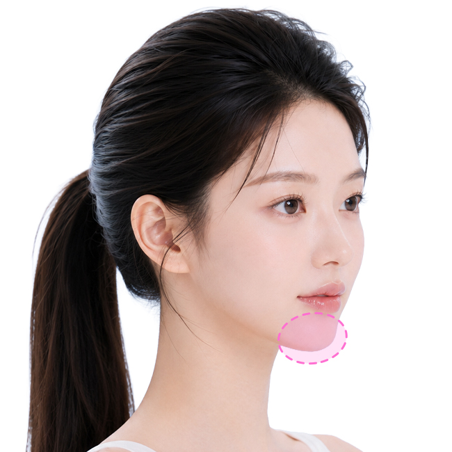 Customized 3D chin implant augmentation