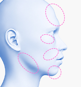 Facial contour before customized facial implant