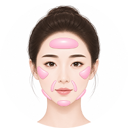 Customized facial implant placement