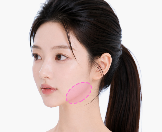 Customized 3D jawline reconstruction implant
